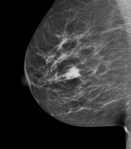 screening-mammogram-image-mediolateral-oblique-view-a-open-i