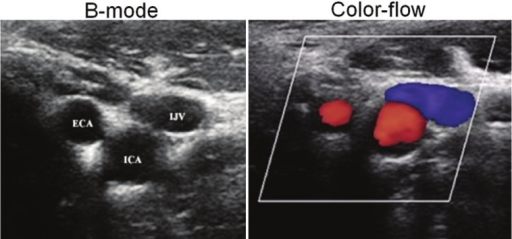 what-do-the-colors-mean-on-a-carotid-ultrasound-the-meaning-of-color