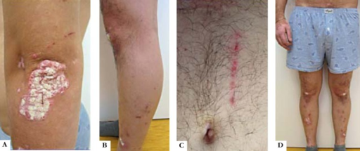 (a), (c-d): Psoriasis patches on the elbow and the legs,(c) Koebner phenomenon with linear psoriasis patch on the abdomen, (c-d): alopecia areata of the lower limbs