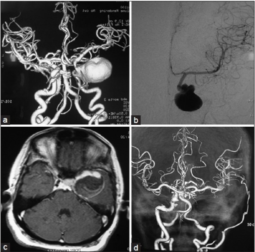 A And B Ct Angiogram And 4 Vessel Dsa Showing A Giant Open I