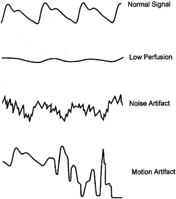 Common pulsatile signals on a pulse oximeter. (Top pane | Open-i