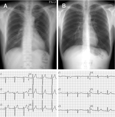 Chest radiographs and electrocardiogram in a normal con | Open-i