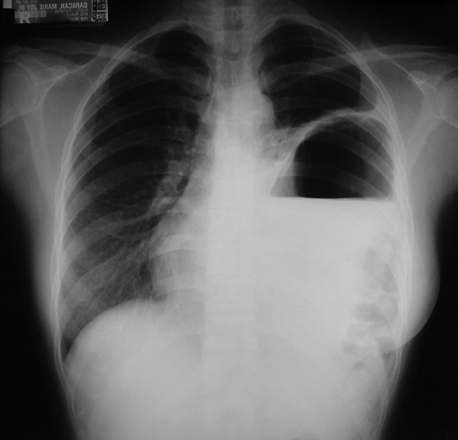 Initial chest x-ray showed air fluid level in left thor | Open-i