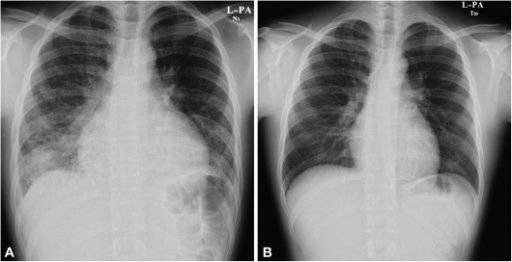 Chest X-ray. A: chest X-ray shows patchy consolidation with multiple nodular densities in both the lower lung fields and cardiomegaly. B: chest X-ray following treatment with steroids shows improving consolidation and cardiomegaly.