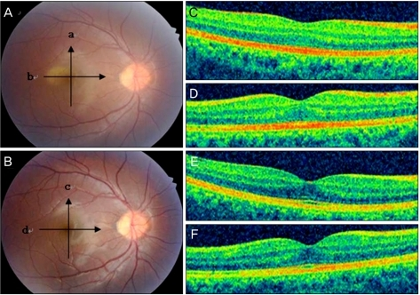 Case 2 A Fundus Photograph Showing Retinal Opacity On The Day Of Trauma Case 2 A Fundus Photograph Showing Retinal Opacity On The Day Of Trauma