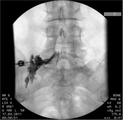 Adverse reaction to epidural steroid injection