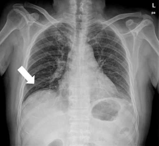 Free Air On Chest X Ray