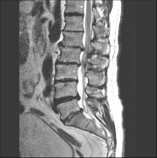 A sagittal view of T2-weighted MRI of lumbar spine show | Open-i