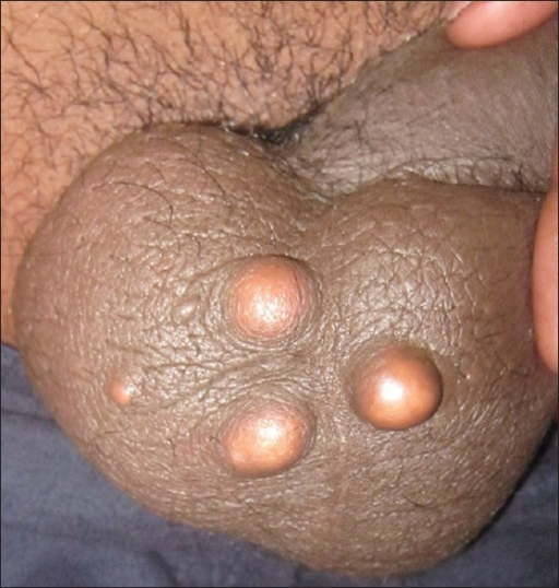 Penis Cysts 112