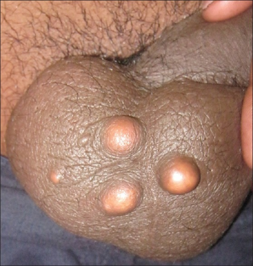 Sebaceous Cysts Penis 53