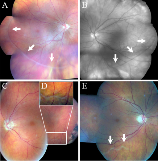 Composite fundus photograph showing several aspects of | Open-i