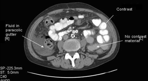 Ct Abdomen With And Without Contrast Showing Differenti Open I
