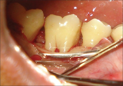 After odontoplasty (right side mirror view) | Open-i