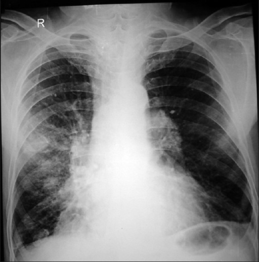 Chest radiograph showing bilateral hilar prominence | Open-i