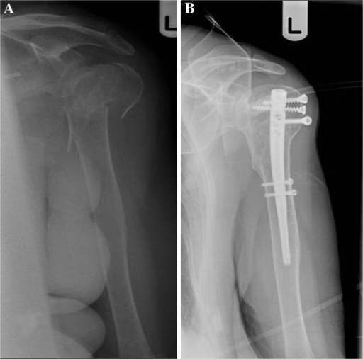 A displaced 3-part proximal humeral fracture (A) treate | Open-i