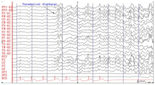 ecg artifact meaning