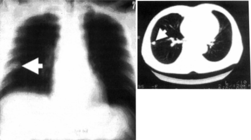 Chest X-ray (left) And CT (right) Appearance Of A Patie | Open-i