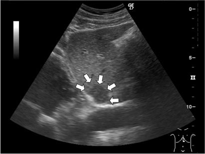 liver ultrasound hypoechoic lesion segment revealed nodular sized cm figure open gastric margins heterogenous clear two intrahepatic