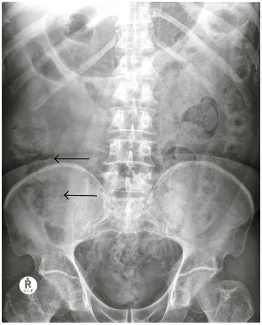 Supine abdomen demonstrates extensive pelvic vascular c | Open-i