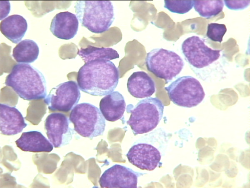 Morphology of acute myeloid leukemia with cuplike blast | Open-i