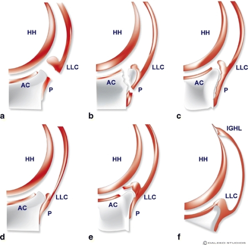 classification-of-bankart-and-bankart-variant-lesions-open-i