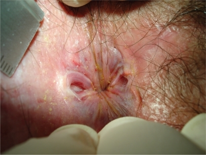 Anal Tear Porn - Anal fissure bleeding - Porn tube