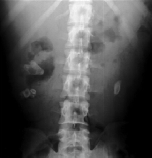 X-ray Kub Of A Patient With Bilateral Renal Stones (lar 