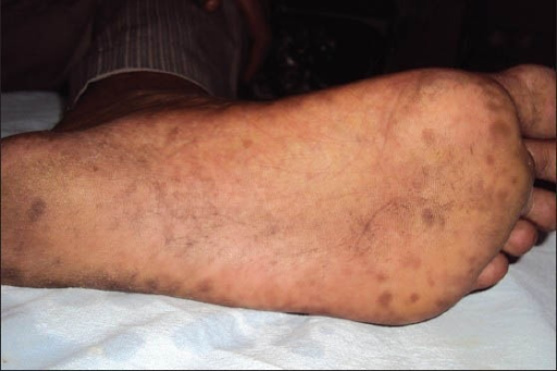 Diabetes And Brown Spots On Bottom Of Feet