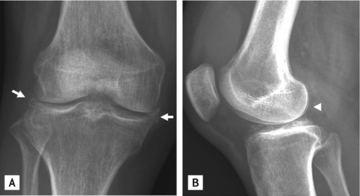 Plain radiographs show multiple calcifications in both | Open-i