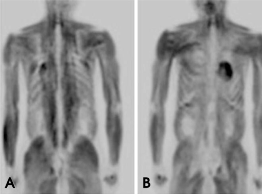 Coronal PET Images Show Diffuse Whole body Muscle Uptak Open i