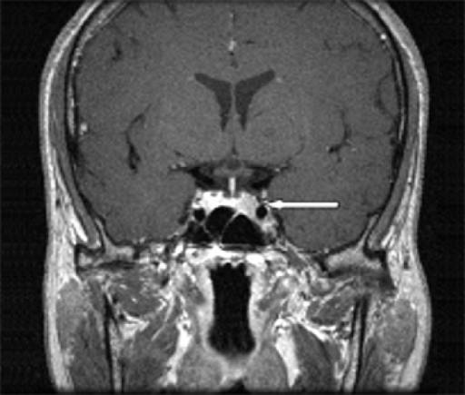 Sellar MRI shows 0.9 × 0.6 mm sized microadenoma in le | Open-i