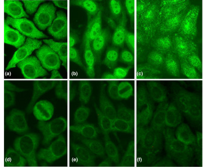 Indirect immunofluorescence staining pattern of anti-Rib-P-positive samples. One anti-Rib-P-positive serum that did not have autoantibodies to other known antigens (a-c) and the Centers for Disease Control and Prevention (CDC) anti-nuclear antibody reference serum number 12 (d-f) were tested at dilutions of 1:500 and 1:100, respectively, on slides from three different suppliers. Significant differences were observed in patterns of staining for the monospecific anti-Rib-P sera (a-c) on HEp-2 substrates from INOVA (San Diego, CA, USA) (a), ImmunoConcepts (Sacramento, CA, USA) (b), and Euroimmun (Lübeck, Germany) (c). Furthermore, the indirect immunofluorescence of the high-titer CDC anti-Rib-P reference serum produced only weak cytoplasmic staining on HEp-2 substrates from the same manufacturers (d-f). Rib-P, ribosomal P protein.