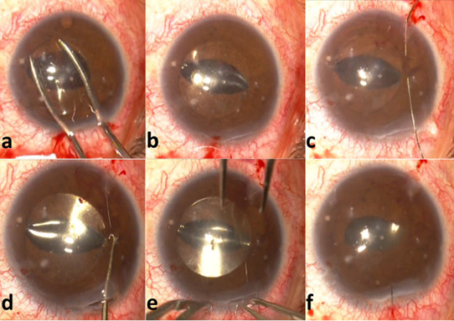 a. Folded 3-piece acrylic PC IOL.b. Optic captured in t | Open-i