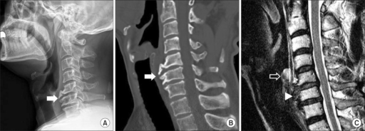 Large anterior osteophytes (arrow) of the C5 and C6 ver | Open-i