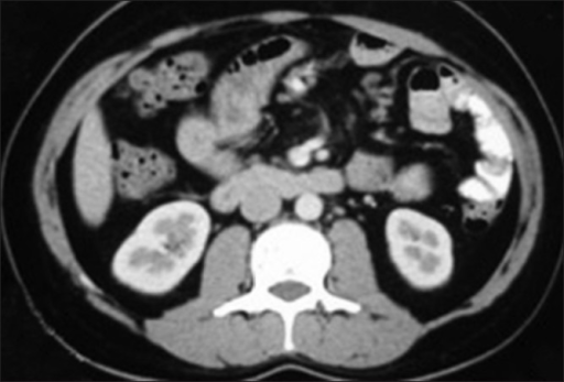 Ct Scan Abdomen Pelvis Retroperitoneal Lymph Nodes Not Open I