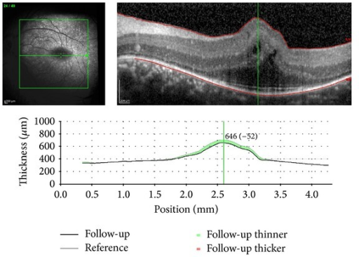 OCT Image Of The Macular Folds Consist Only Sensorial Retina Without Involvement OCT Image Of The Macular Folds Consist Only Sensorial Retina Without Involvement