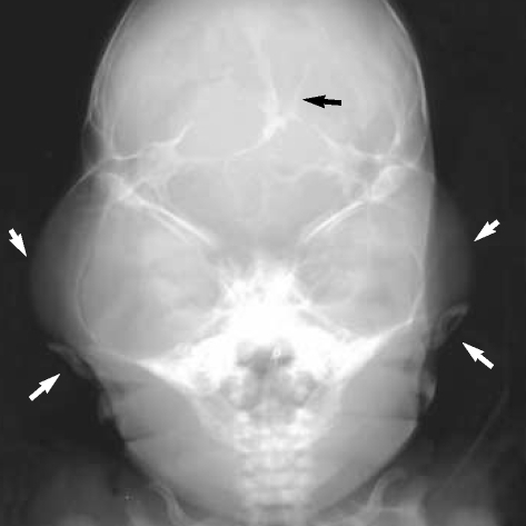 Skull AP view showed typical 