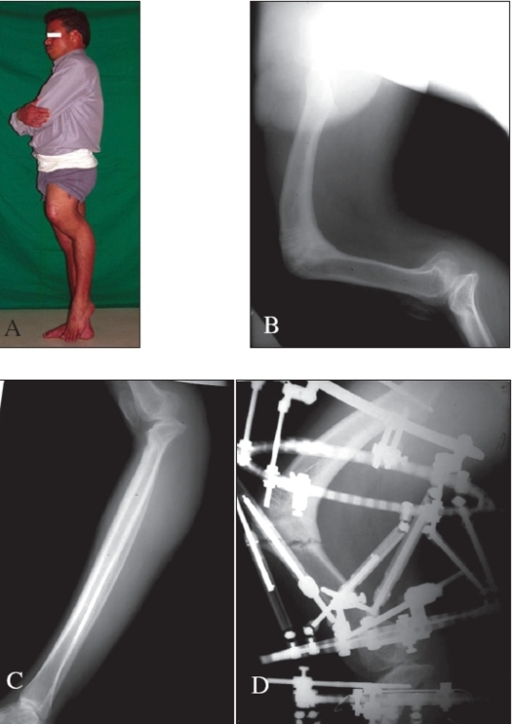 A) Severe deformities in sagittal plane after childhod | Open-i