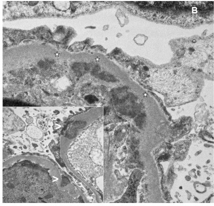 Electron microscopy. Ultrastructural appearance of a gl | Open-i