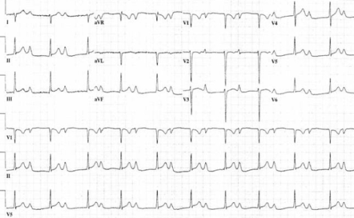 Showing extreme prolongation of PR interval, biatrial e | Open-i