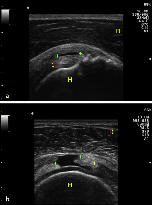 Supraspinatus Tendon tears. Panel a) Longitudinal scan: | Open-i