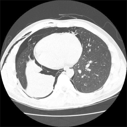 atelectasis ct chest complete open axial shows pneumomediastinum policy copyright access lung figure right