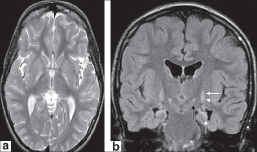 (a) Axial T2-weighted image reveals symmetric hyperinte | Open-i