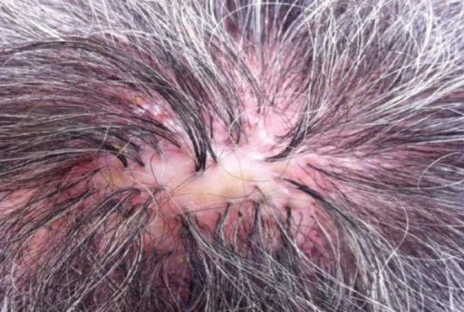 A fibrotic erythematous alopecia plaque with polytrichi | Open-i