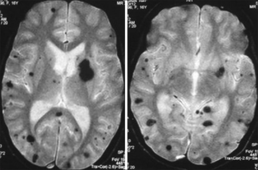 Follow-up GRE MR image, done after 72 h, shows multifocal areas of ...