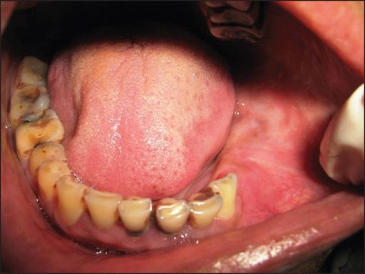 Clinical photograph showing the swelling in the mandibu