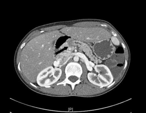 CT scan of abdomen with pancreatic mass (arrow). | Open-i