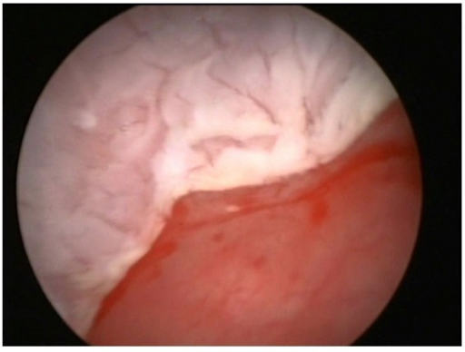 The cystoscopy revealed a whitish thin plaque clearly d ...