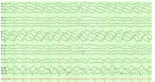 Temporal Intermittent Rhythmic Delta Activity (tirda) R 