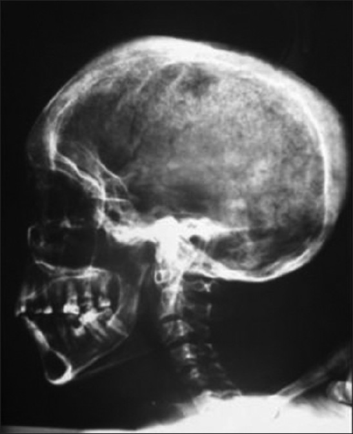 Lateral Skull X Ray Showing Thickening Of Diploic Space Open I